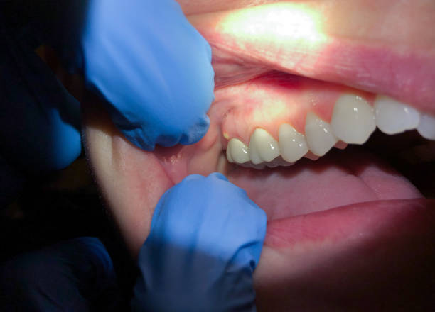 Best Emergency Dental Care for Broken or Chipped Teeth in Rheems, PA