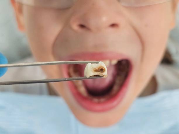 Best Emergency Wisdom Teeth Removal in Rheems, PA